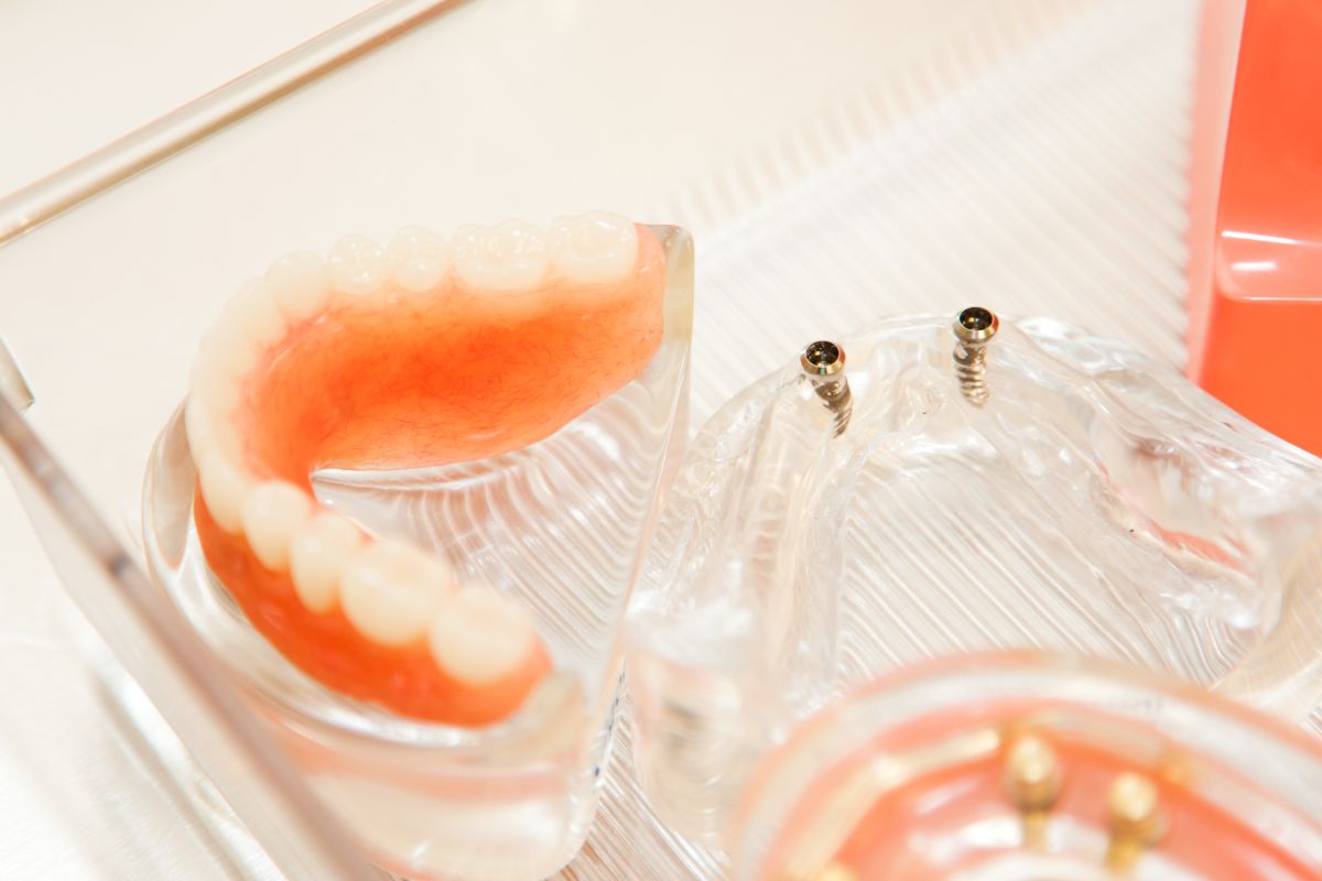 manutenzione impianti dentali