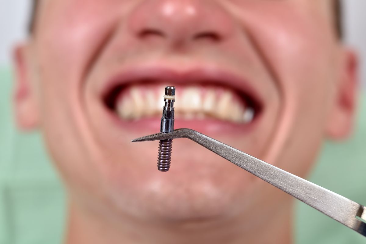 impianto dentale in titanio